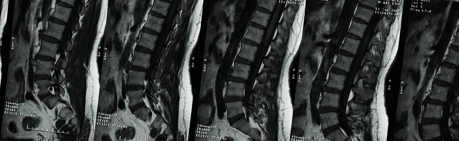 Medical imagery of the lower spine